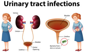 Does UTI Cause Bloating?