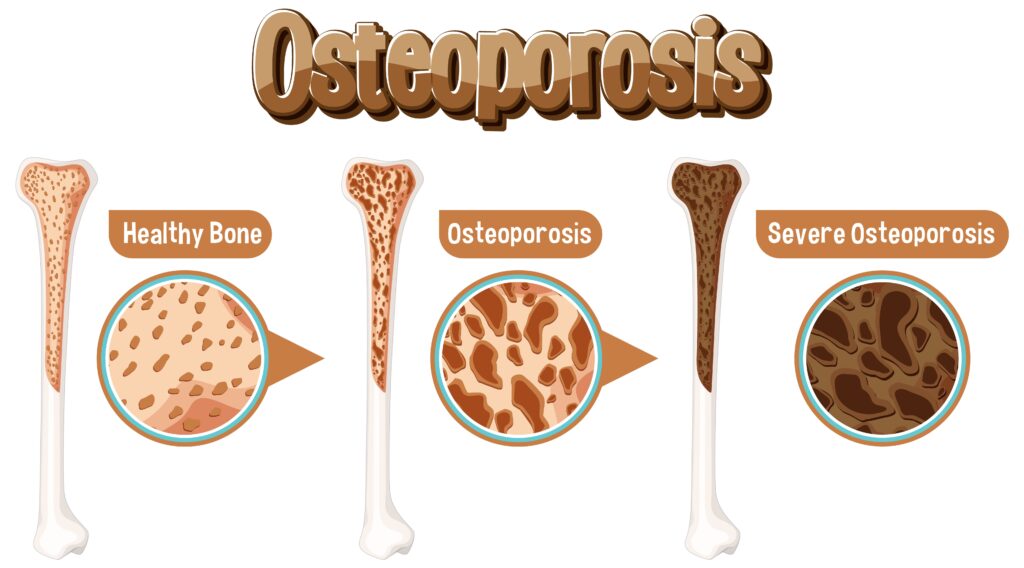 Is Osteoporosis a Disability