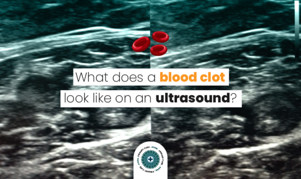 What Does a Blood Clot Look Like on An Ultrasound? - Primary Care of Kansas