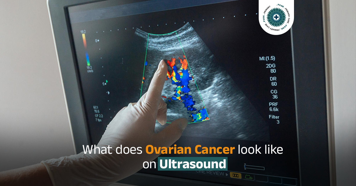 Ovarian Cancer