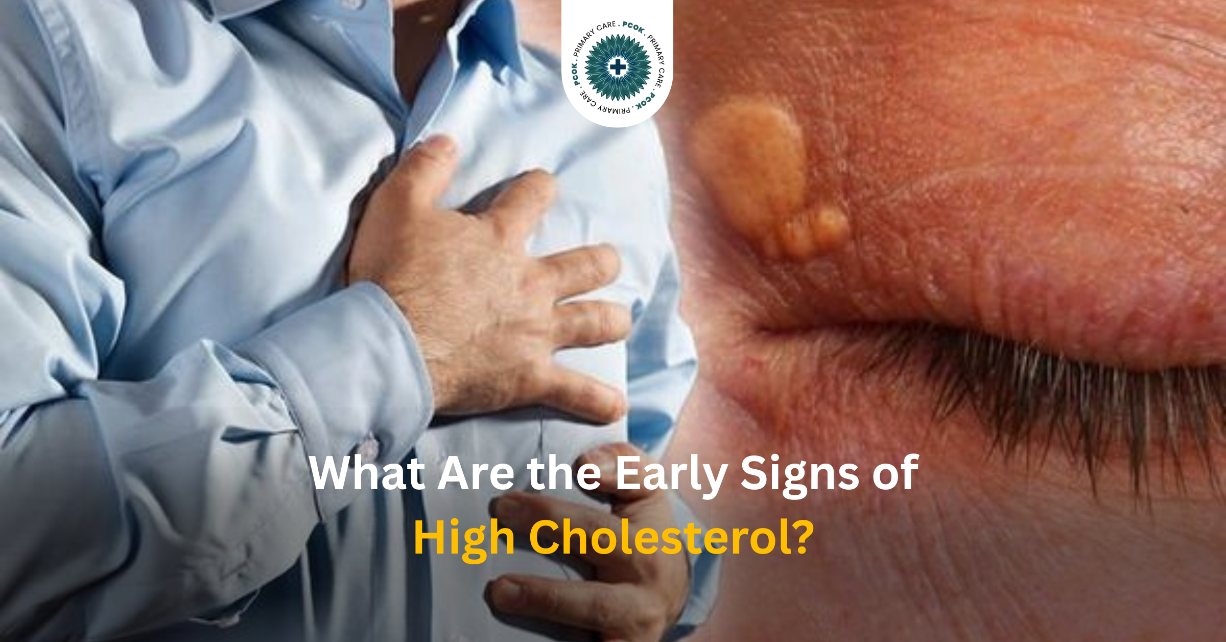High Cholesterol